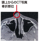 鼻骨骨折 頭上からのCT写真 骨折部位